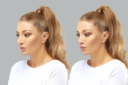 Botox before and after results 1