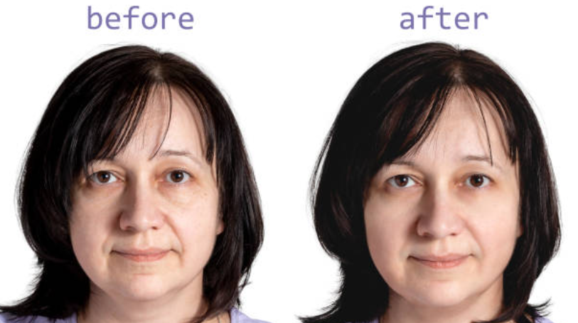 Botox before and after results 3