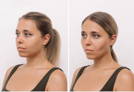 Botox before and after results 4