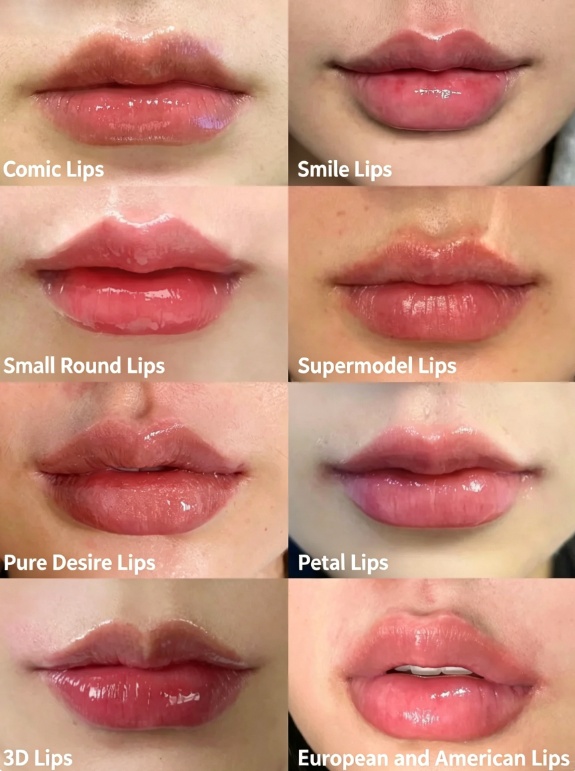 Irvine Juvederm filler patients