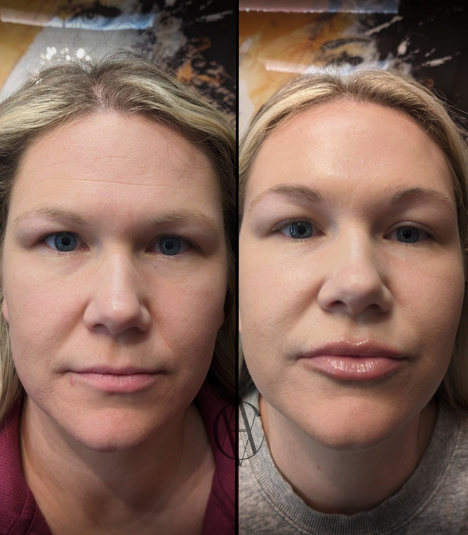 Lip filler before / after 1
