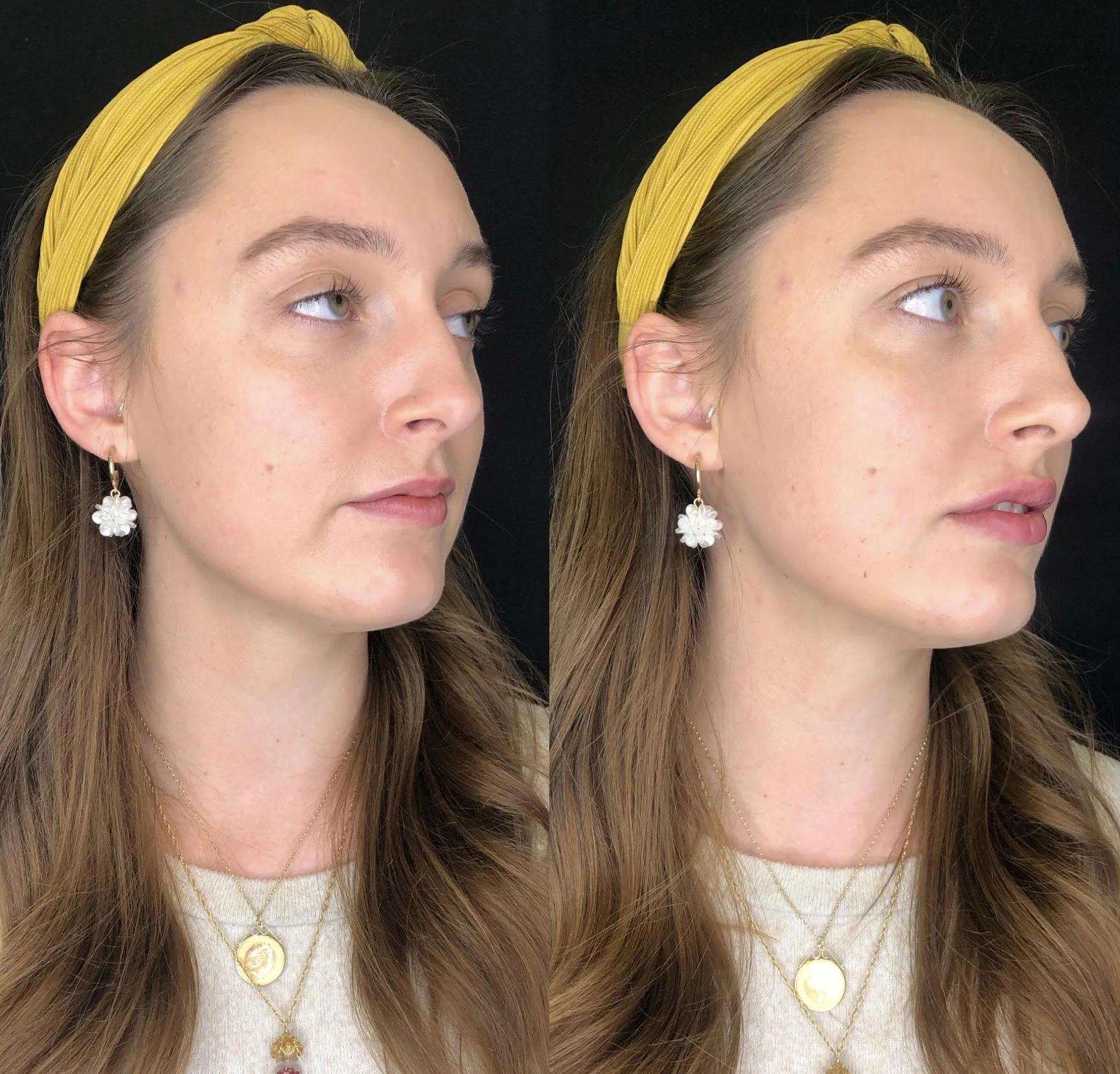 Lip filler before / after 2