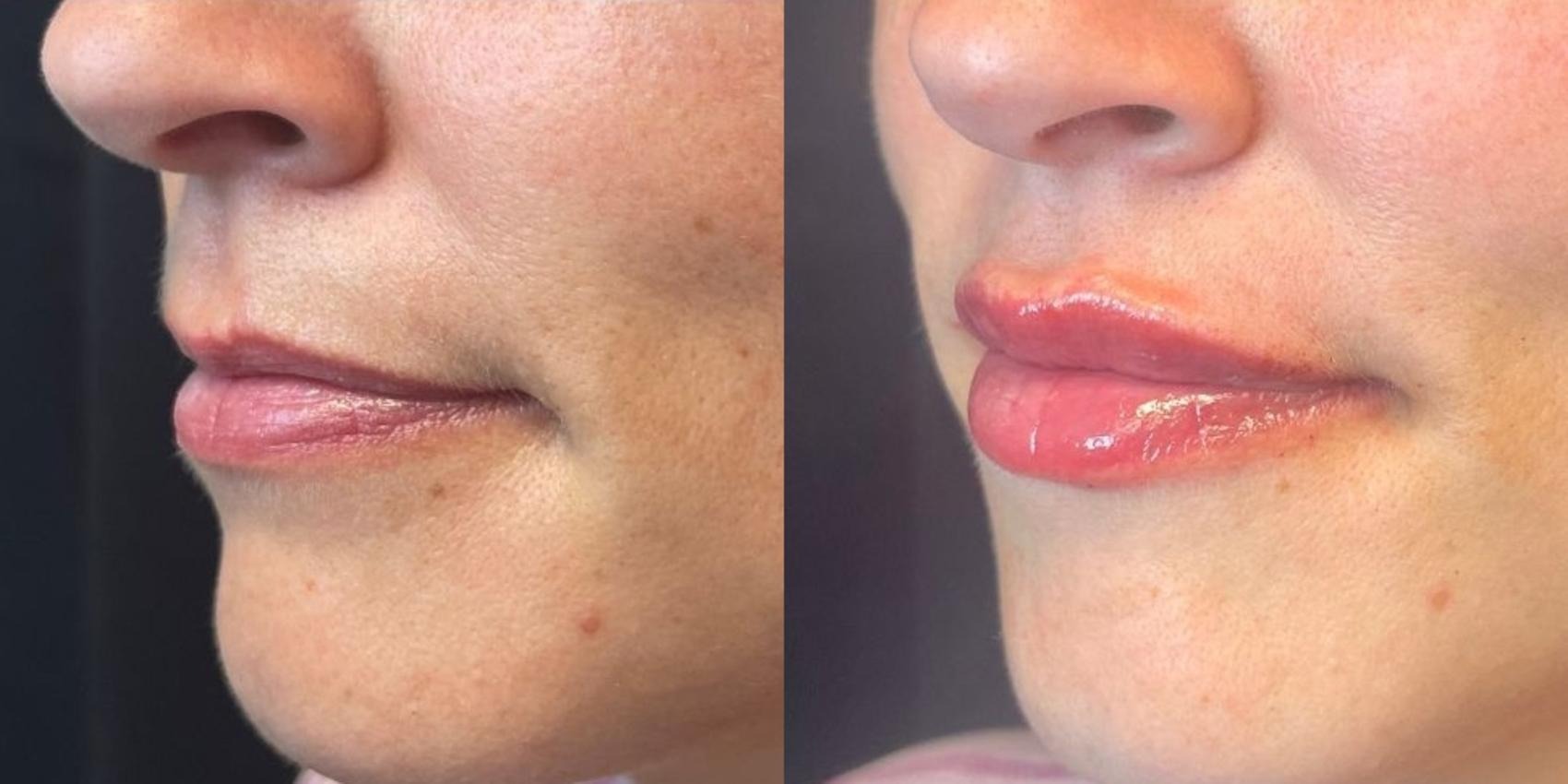 Lip filler before / after 4