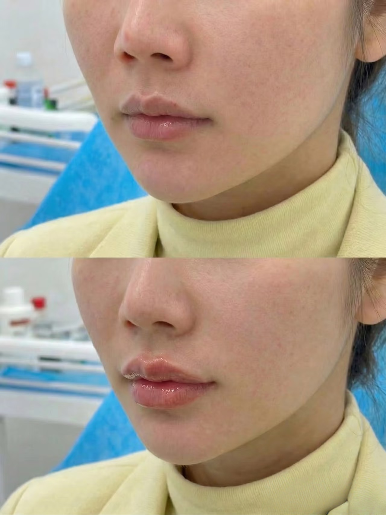 Restylane before / after 1