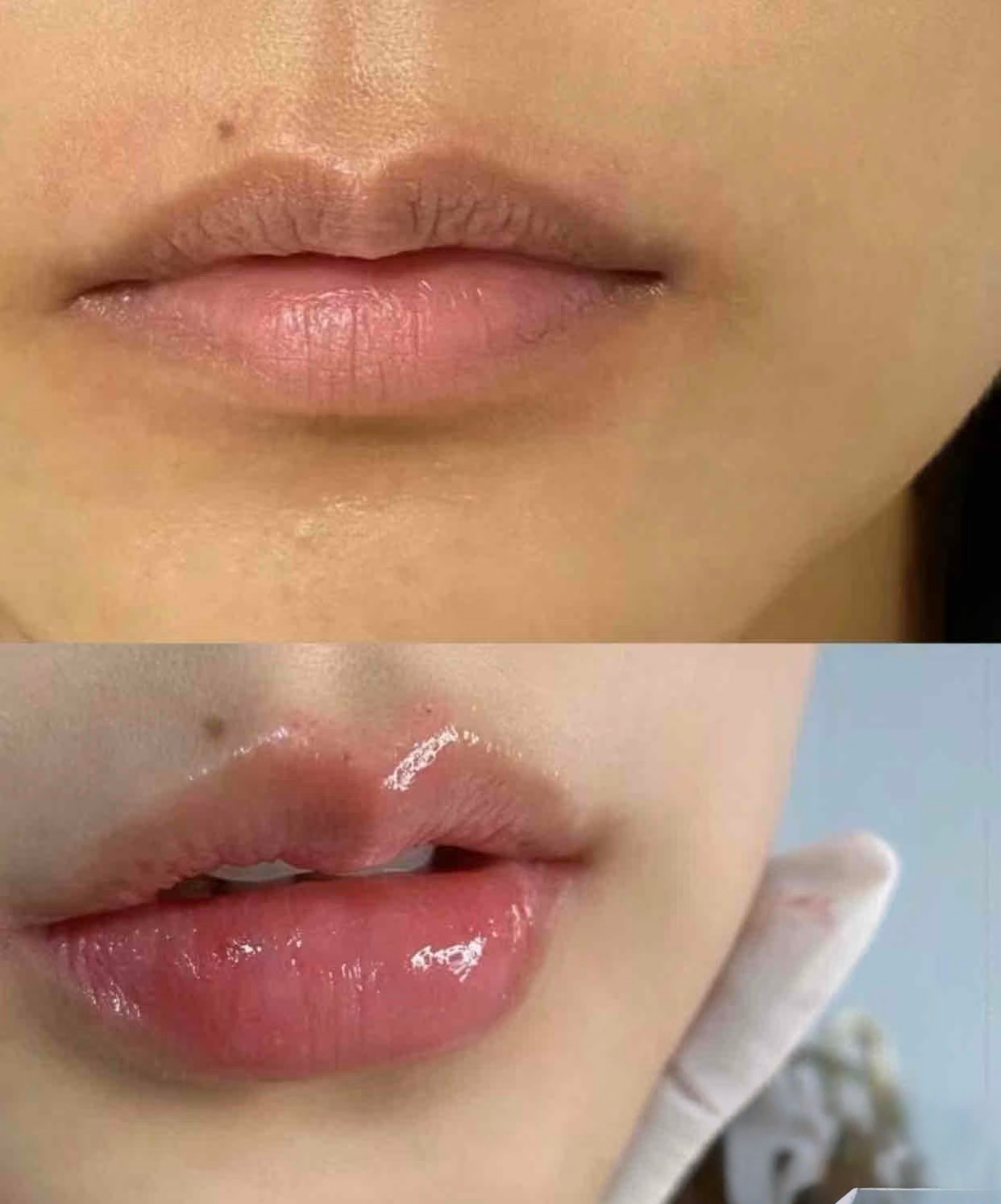 Restylane before / after 2
