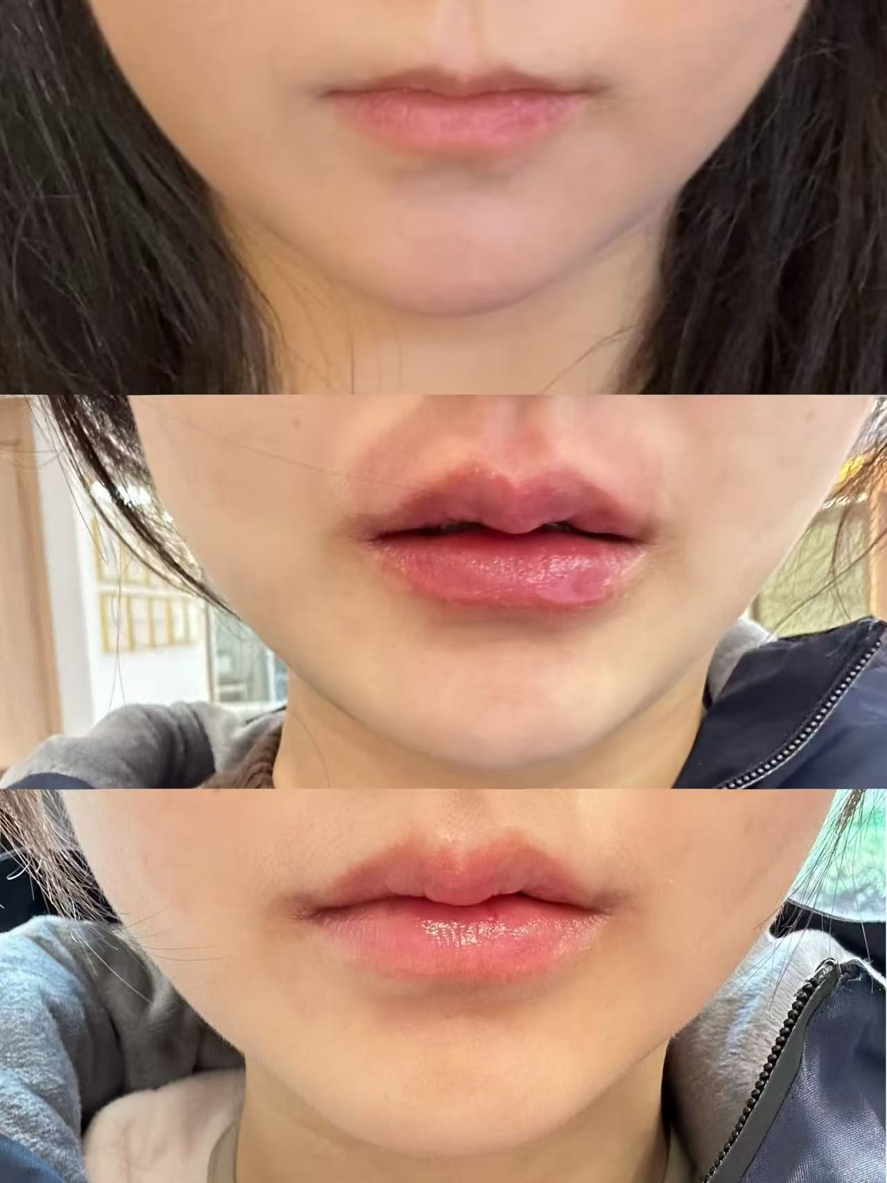 Restylane before / after 3