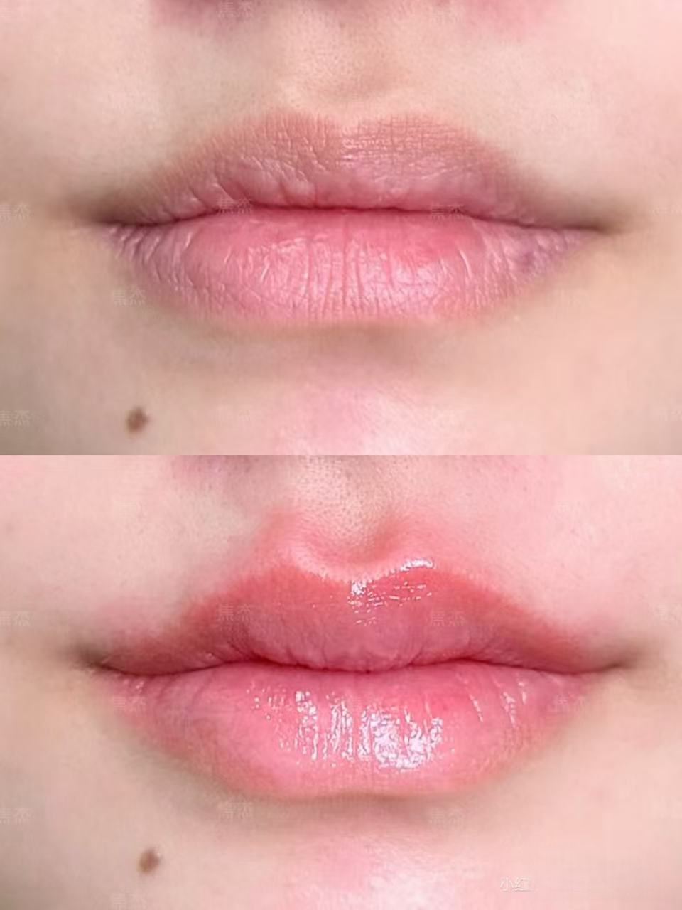 Restylane before / after 4