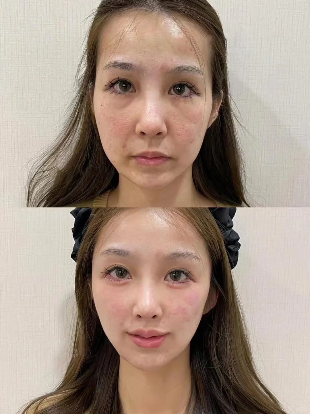 Sculptra before / after — cheeks & midface 1