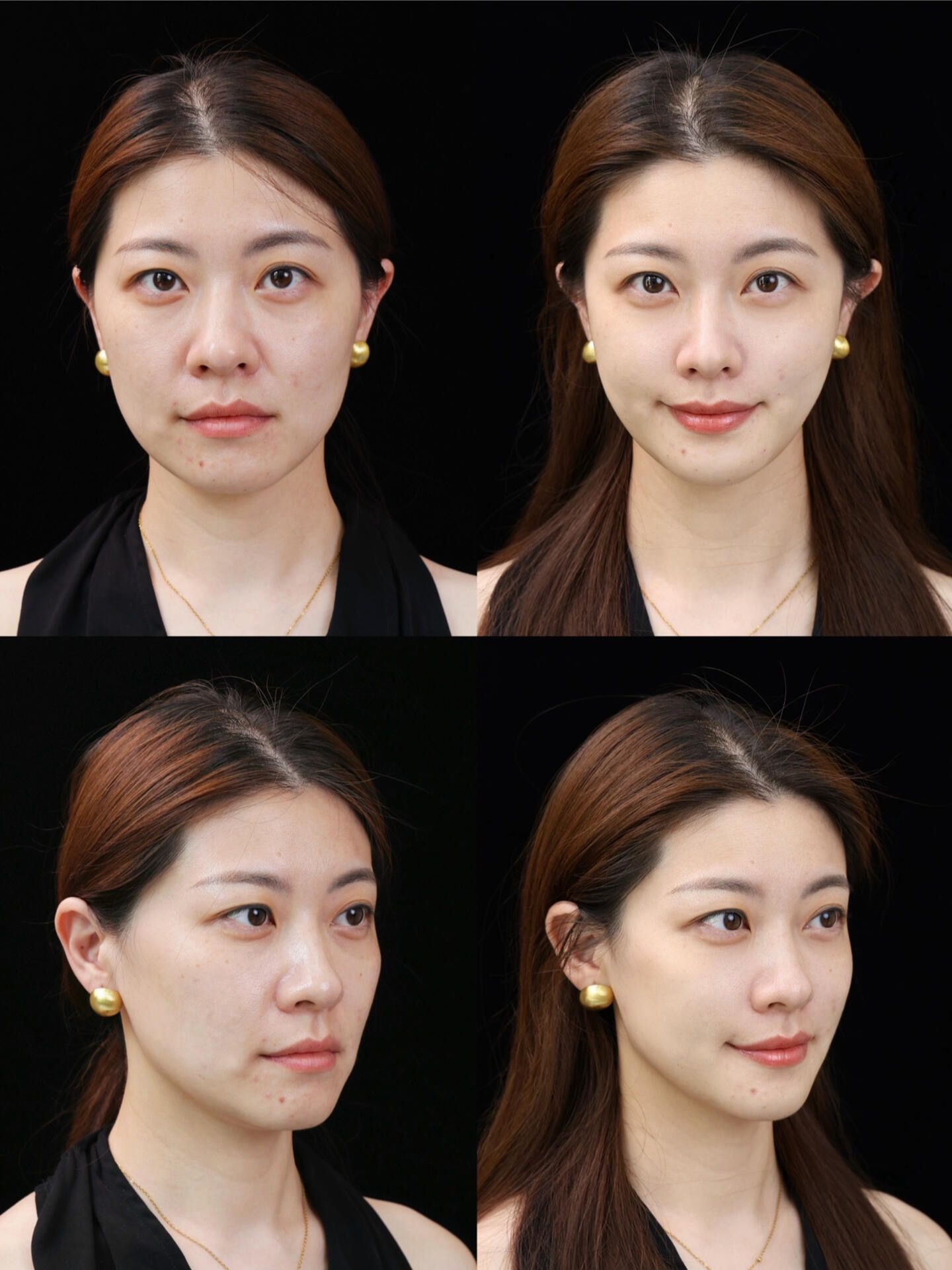 Sculptra before / after — temples & volume 2