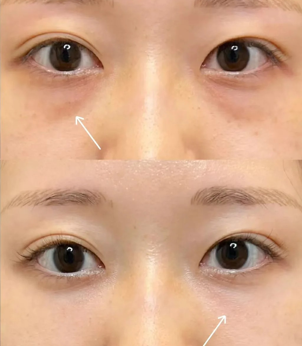 Before / After 4