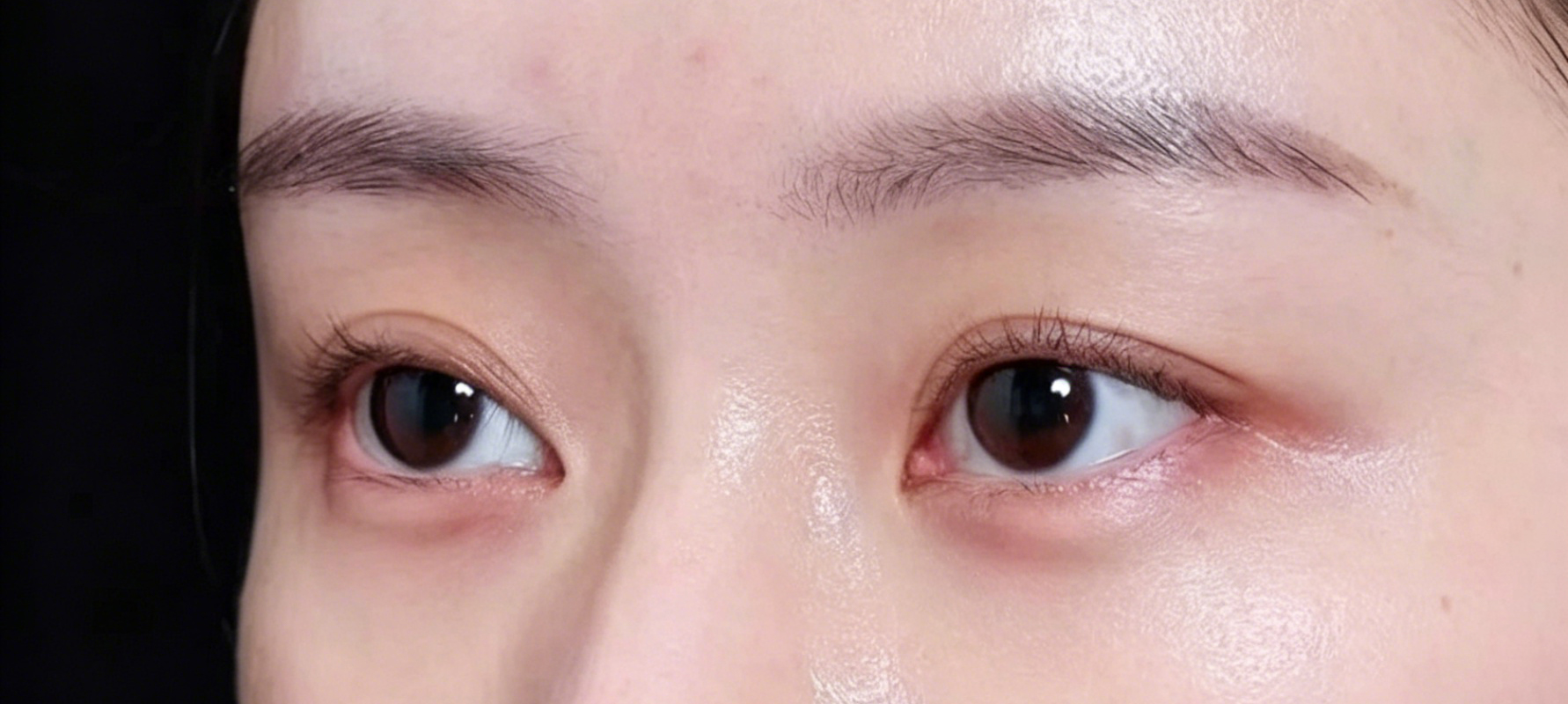 Under eye filler — after treatment