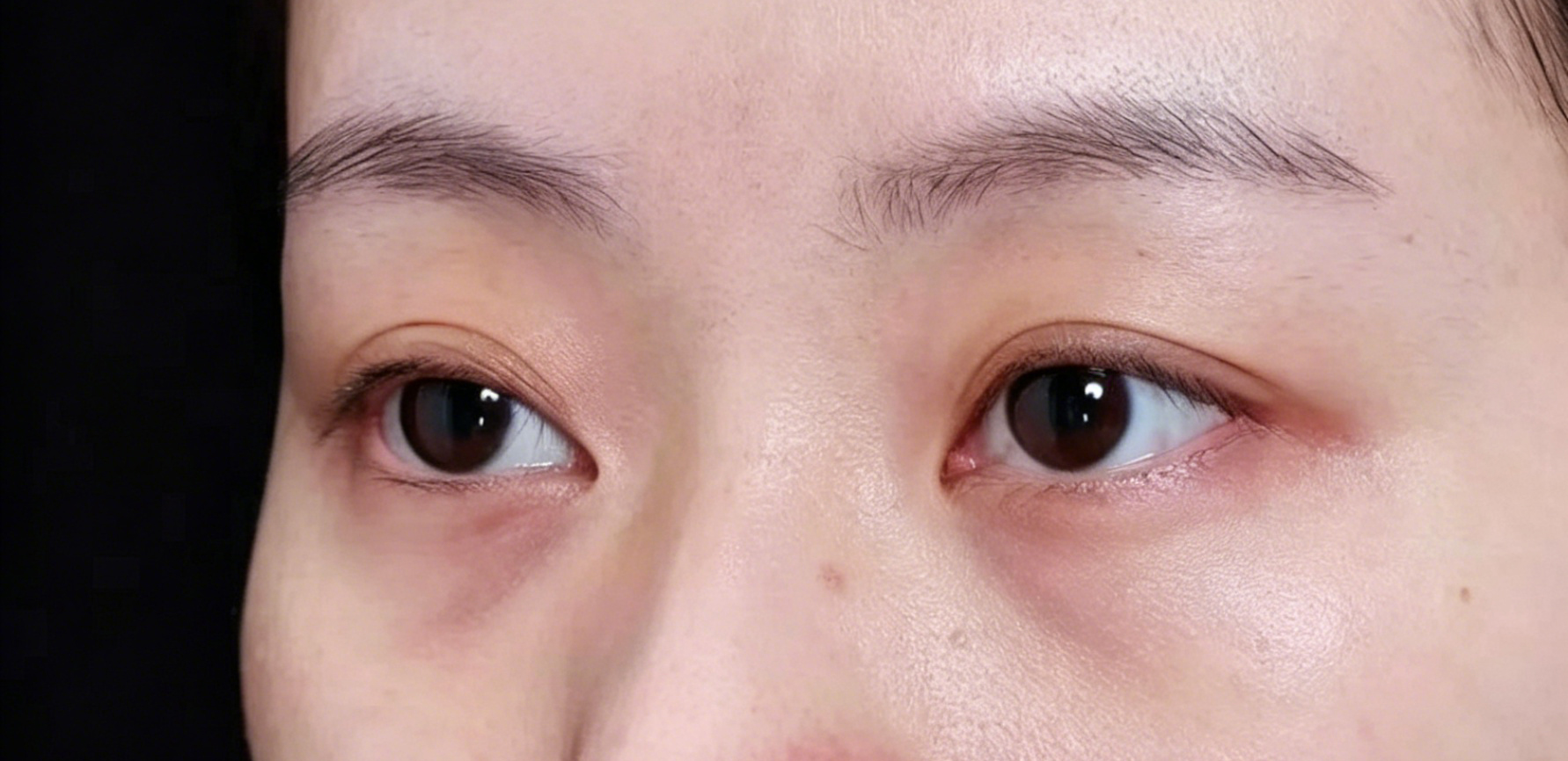 Under eye filler — before treatment