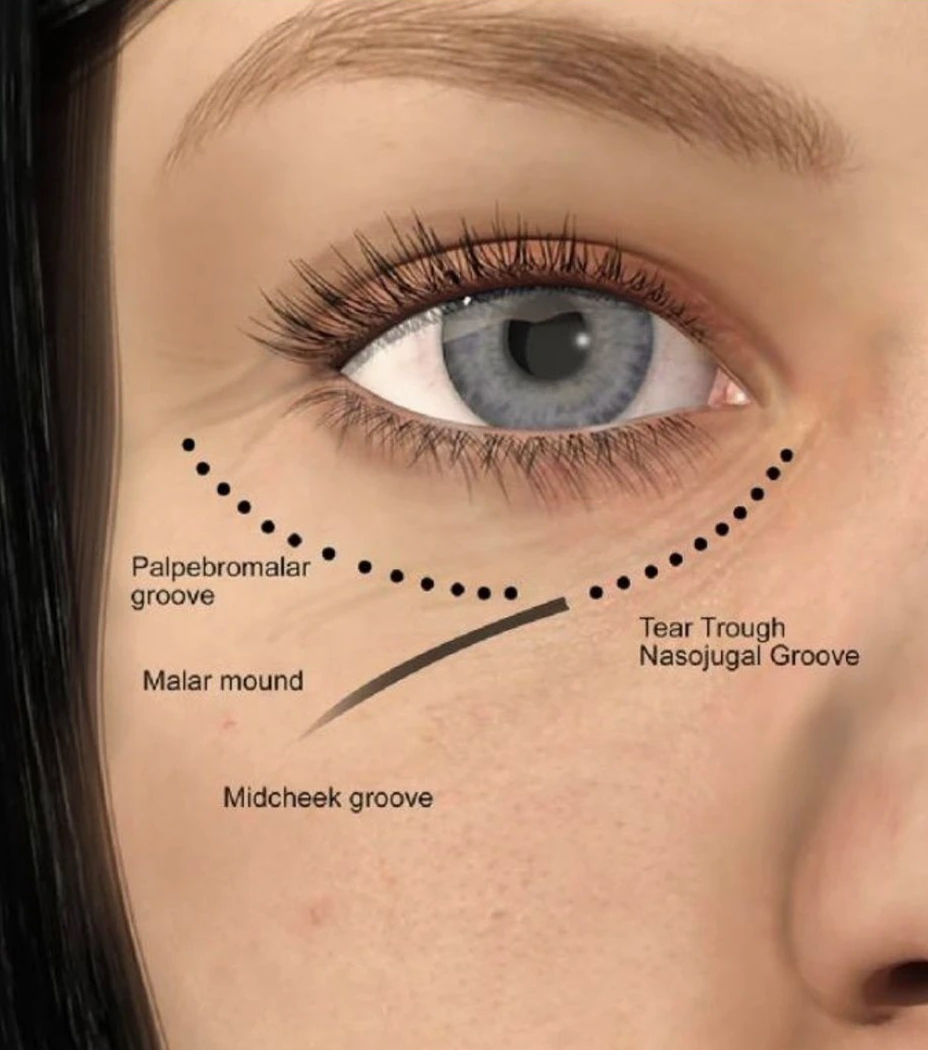 Periorbital anatomy — thin under-eye skin