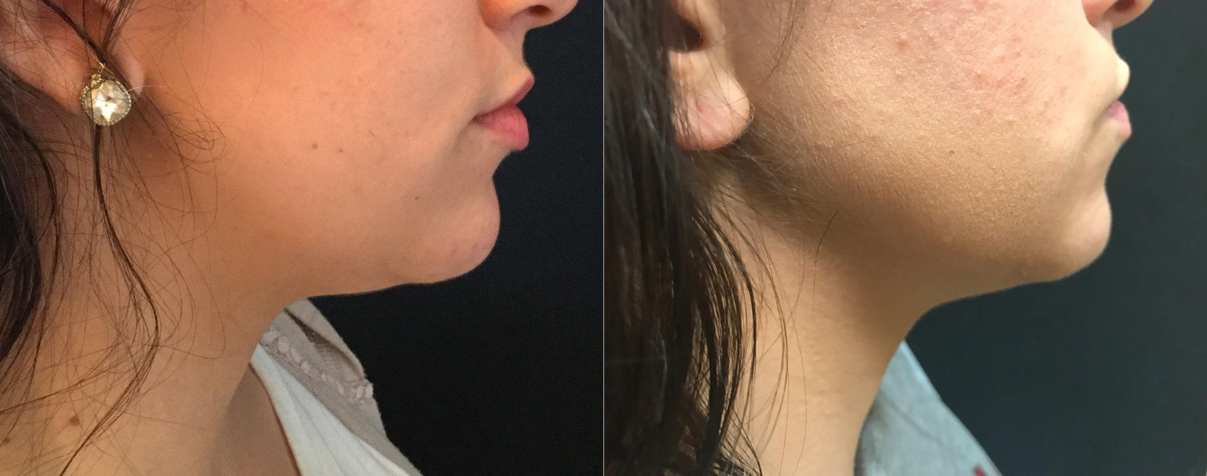 Kybella before / after — chin 1