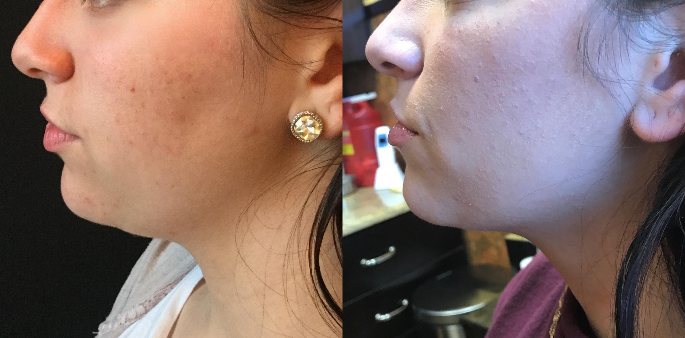Kybella before / after — chin 2