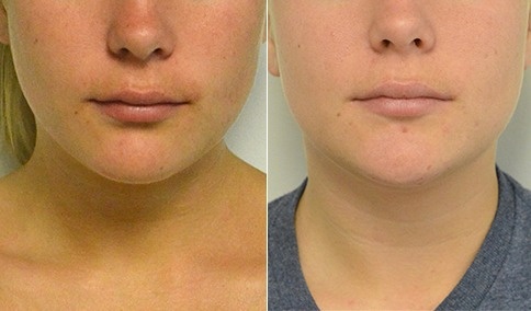 Kybella before / after — chin 3