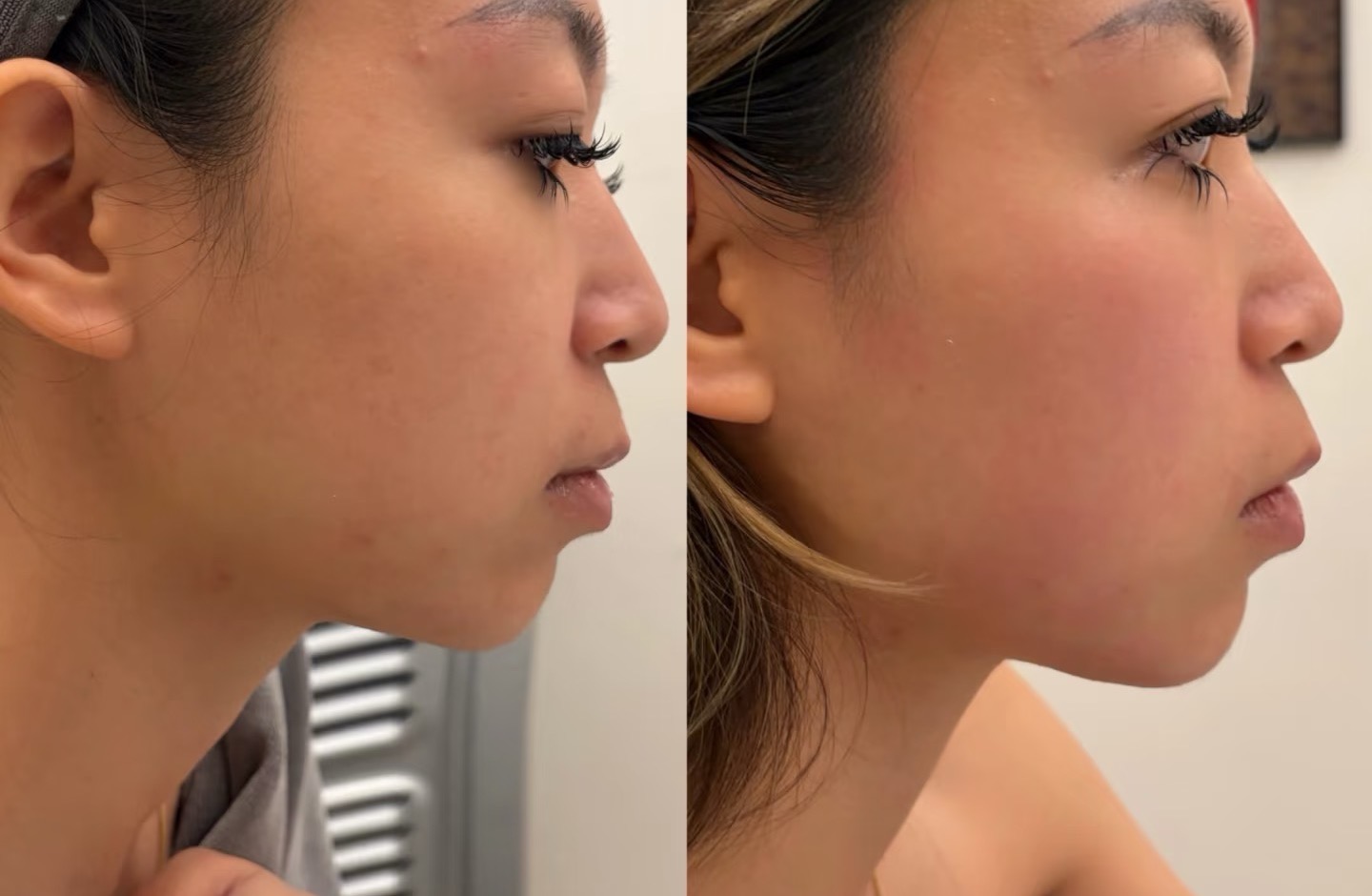 Kybella before / after — chin 4