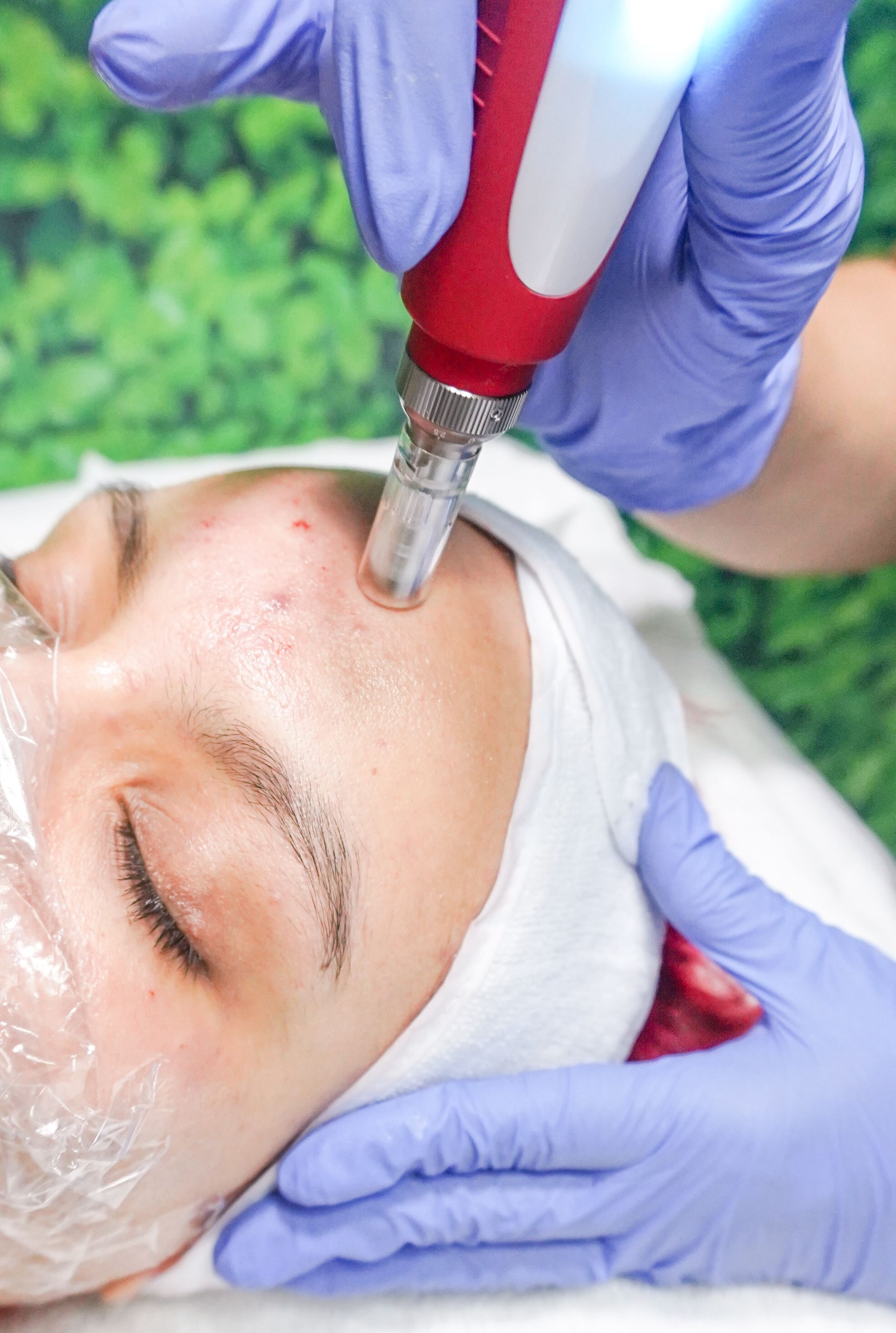 Microneedling Irvine
