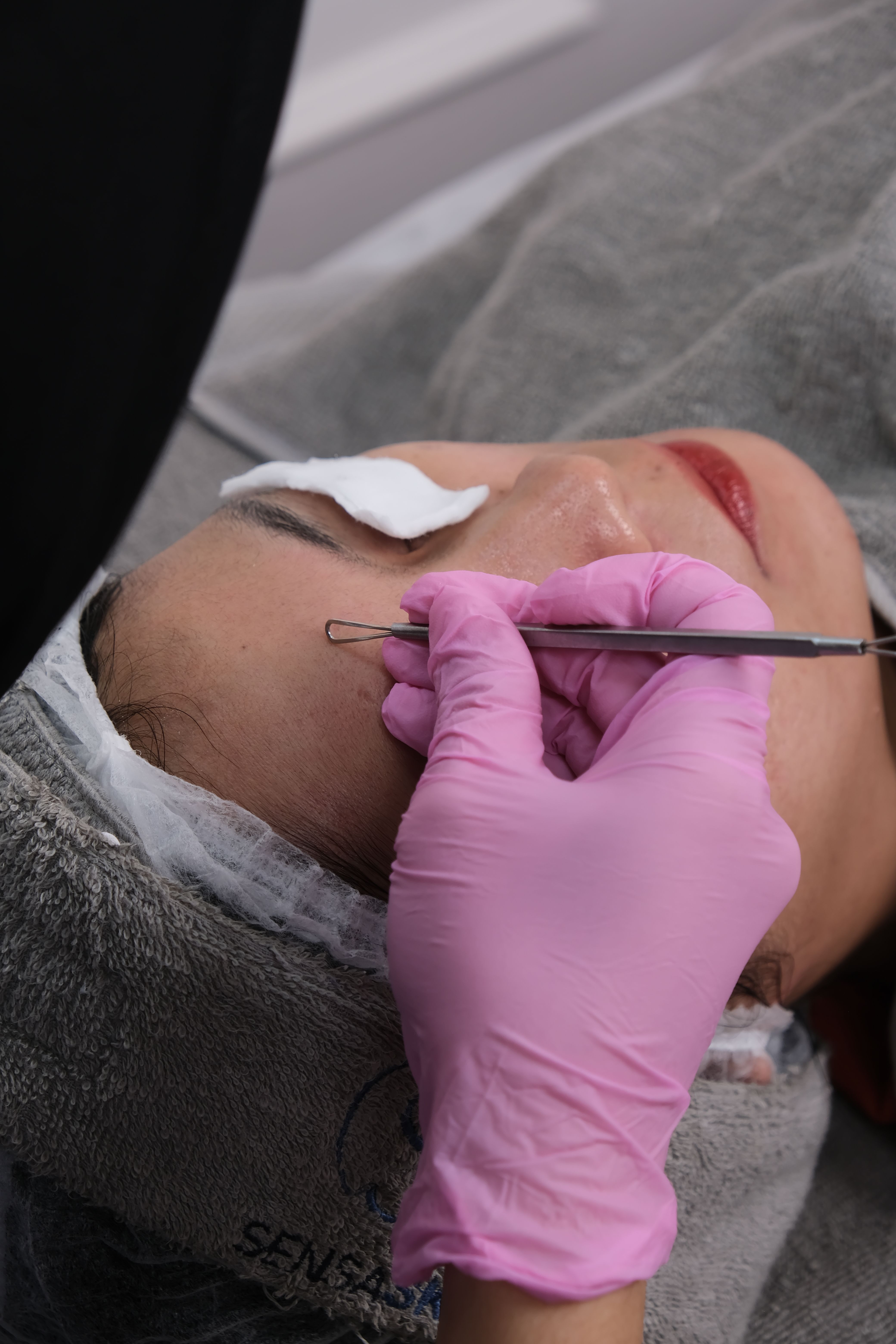 Professional comedone extraction