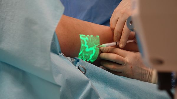 Sclerotherapy Irvine